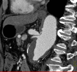 Celiac Stenosis With Post Stenotic Dilation- Median Arcuate Ligament Syndrome (MALS) - CTisus CT Scan