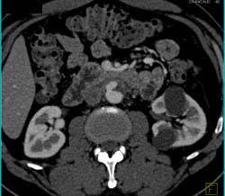 Vasculitis With Multiple Aneurysms - CTisus CT Scan