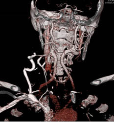 Carotid Stenosis - CTisus CT Scan