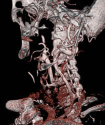 Carotid Stenosis - CTisus CT Scan