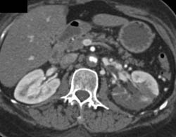 Multiple Renal Infarcts - CTisus CT Scan