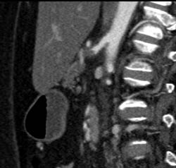 Occluded Celiac Axis - CTisus CT Scan