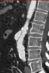 Ulceration of Aorta - CTisus CT Scan