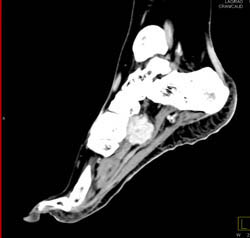 Synovial Sarcoma With Edits - CTisus CT Scan