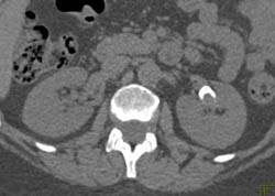 Renal Artery Aneurysm - CTisus CT Scan