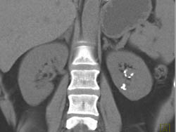 Renal Artery Aneurysm - CTisus CT Scan