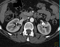 Renal Artery Aneurysm - CTisus CT Scan