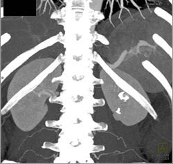 Renal Artery Aneurysm - CTisus CT Scan