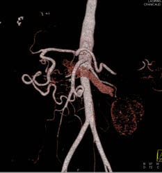 Dilated Gastroduodenal Artery (GDA) in Patient With Celiac Artery Stenosis - CTisus CT Scan