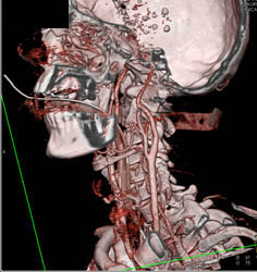 Carotid Stenosis - CTisus CT Scan