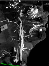 Carotid Stenosis - CTisus CT Scan