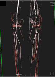 Iliac Occlusion With CTA Runoff With Edits - CTisus CT Scan