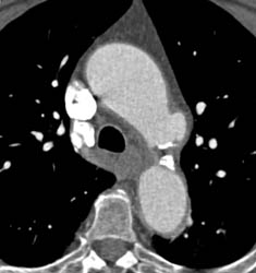 Focal Arch Aneurysm - CTisus CT Scan