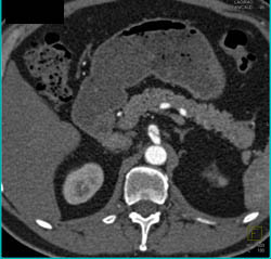 Dissection of Celiac Artery - CTisus CT Scan