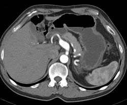 Post Stenotic Dilation of Celiac Artery - CTisus CT Scan