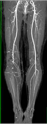 Runoff Study With Occluded Right Popliteal Artery - CTisus CT Scan