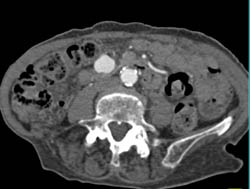 Huge Collaterals Around Gastroduodenal Artery (GDA) and Superior Mesenteric Vein (SMV) - CTisus CT Scan