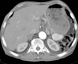 Accessory Spleen Looks Like Splenic Artery Aneurysm - CTisus CT Scan