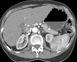 Fibromuscular Dysplasia (FMD) - Right Renal Artery - CTisus CT Scan