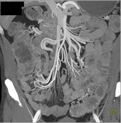 Nice Ilio-colic Trunk in Crohn Disease - CTisus CT Scan