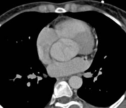 Bicuspid Valve With Aortic Stenosis and Dilated Aortic Root - CTisus CT Scan