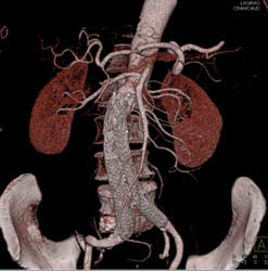 Mesenteric Tree Shown With MIP and VRT - CTisus CT Scan