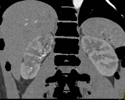 Polyarteritis Nodosa Involves Liver and Kidney - CTisus CT Scan