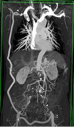 Axillary-fem and Fem-fem Bypass Grafts - CTisus CT Scan