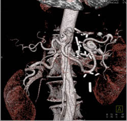 Splenic Artery Aneurysm - CTisus CT Scan