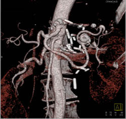 Ectatic Abdominal Aorta With VRT and MIP - CTisus CT Scan