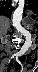 SVC Occlusion With Collaterals in Chest Wall and Tumor in Right Atrium - CTisus CT Scan