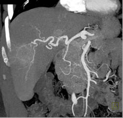 Ct Angiogram With Neovascularity Shows Hepatoma - CTisus CT Scan