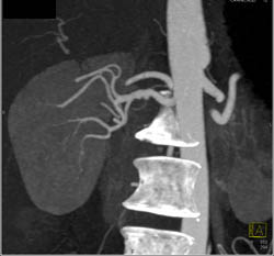 Fibromuscular Dysplasia (FMD) Right Renal Artery - CTisus CT Scan