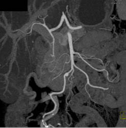 Small Aneurysm Off SMA - CTisus CT Scan