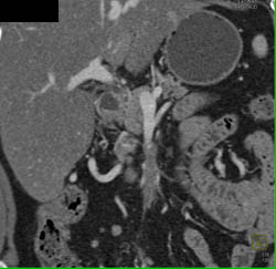 Superior Mesenteric Vein (SMV) Occlusion Due to Sclerosing Mesenteritis - CTisus CT Scan