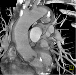 Ductus Aneurysm - CTisus CT Scan