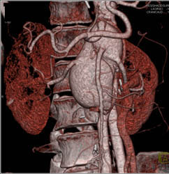 Focal Aneurysm Off SMA - CTisus CT Scan