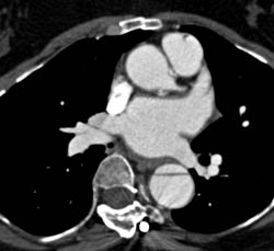 Type A Dissection - CTisus CT Scan