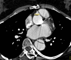 Type A Dissection - CTisus CT Scan