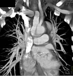 Type A Dissection - CTisus CT Scan