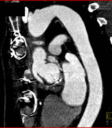 Repaired Arch and Root - CTisus CT Scan