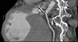 Patent Bypass Grafts - CTisus CT Scan