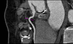 Patent Bypass Grafts - CTisus CT Scan