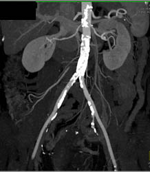 Stent in Superficial Femoral Artery (SFA) - CTisus CT Scan