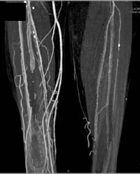 Diseased SFA and Popliteal Artery - CTisus CT Scan