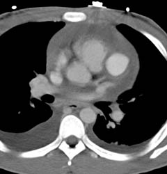 LAD Aneurysm With Hemoperitoneum - CTisus CT Scan