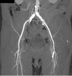 Iliac Artery Has Plaque - CTisus CT Scan