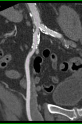 Diseased Iliac Artery With Plaque - CTisus CT Scan