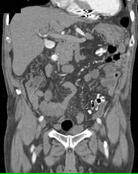 Hepatic Artery Aneurysm - CTisus CT Scan