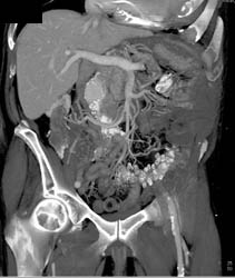 Hepatic Artery Aneurysm - CTisus CT Scan